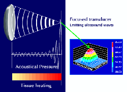 focused-transducer-ablatherm-hifu